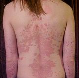 Psoriasis del cuero cabelludo y dermatitis seborreica: ¿Cuál es la diferencia?