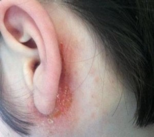 dermatitis-oreja