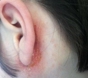 dermatitis-oreja