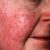 Tratamiento para la dermatitis seborreica en la cara